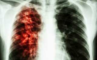 Группы диспансерного учета при туберкулезе