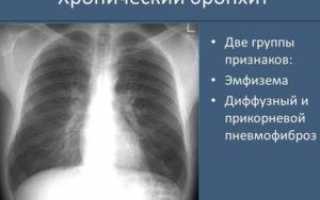 Бронхит на снимке рентгена