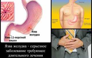 Интересные средства лечения язвы желудка