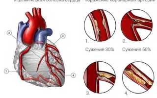 Ишемическая болезнь сердца