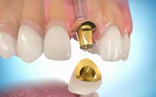 Почему мы должны заменять отсутствующие зубы