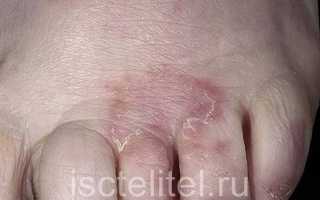 Грибок кожи между пальцами ног
