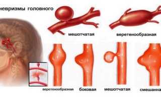 Мешотчатая аневризма артерии головного мозга