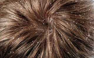 Лечение перхоти народными средствами