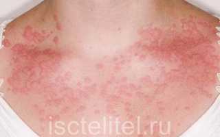 Пищевая аллергия у взрослых, ее симптомы и лечение