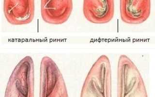 Запах хлорки в носу причины