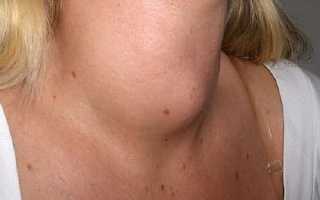 Лечение гипертиреоза народными средствами