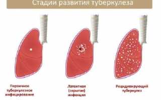 Инфильтративный туберкулез легких лечение сроки лечения