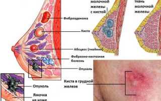 Народные методы лечения кисты