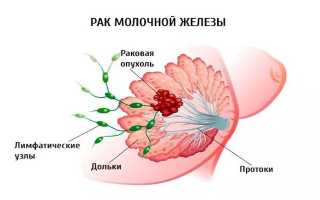 Болезни молочных желез