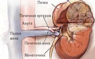 Ангиомиолипома почки — что это?