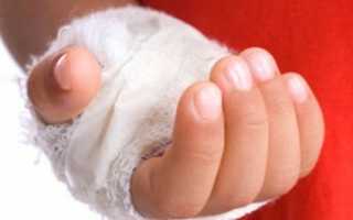 Народные средства при ожогах кожи