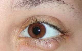 Народные средства лечения халязиона