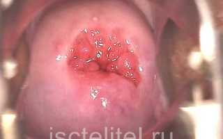 Можно ли вылечить эрозию шейки матки?