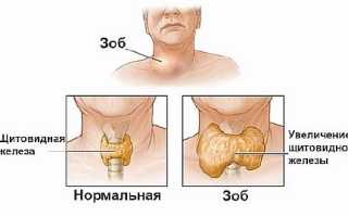 Зоб щитовидной железы — причины и лечение народными средствами