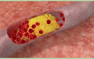 Лечение атеросклероза сосудов народными средствами