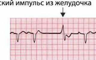 Желудочная экстрасистолия что это