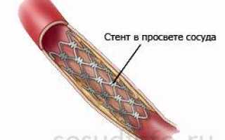 Физические нагрузки после стентирования сосудов сердца