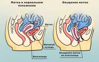 Современная диагностика опущения матки без боли и страха