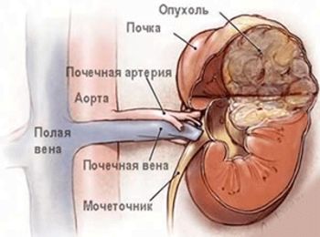 Ангиомиолипомы почки - опасна ли?