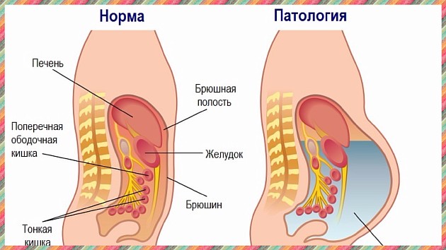 Асцитоз