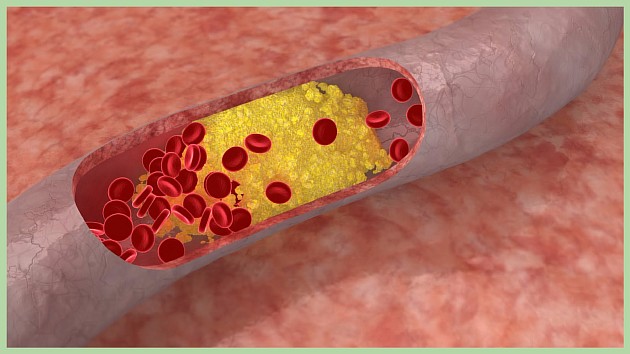 Атеросклероз сосудов