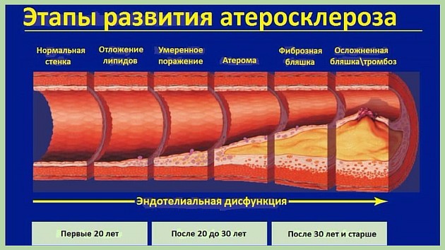 Стадии развития атеросклероза