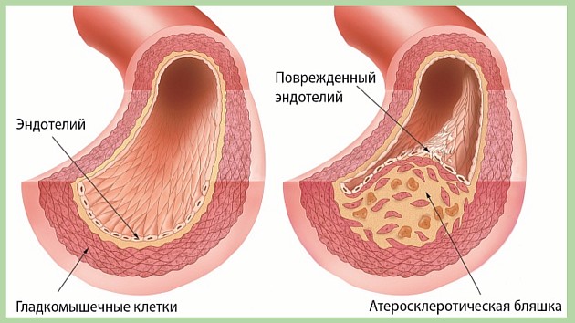 Бляшки на сосудах