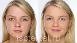 Лечение демодекоза народными средствами
