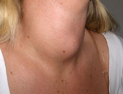 Лечение гипертиреоза народными средствами