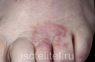Грибок кожи между пальцами ног
