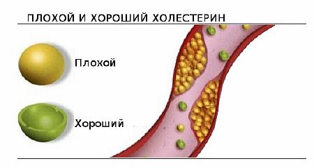 Причины повышения холестерина в крови