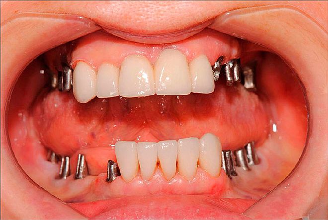 Почему мы должны заменять отсутствующие зубы