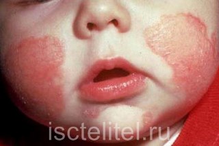 Разновидности крапивницы