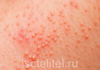 От чего появляется крапивница?