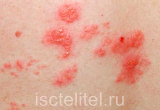 Народный метод лечения крапивницы