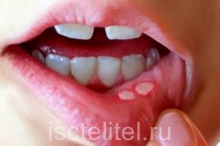 Стоматит