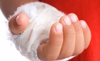 Ожог на руке