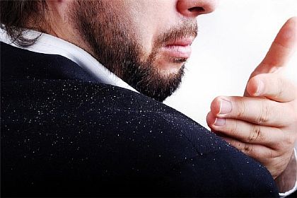 Перхоть у мужчин