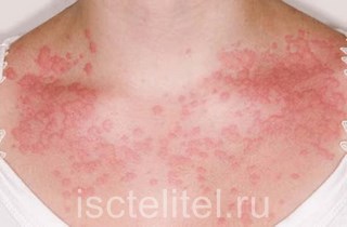 Пищевая аллергия у взрослых