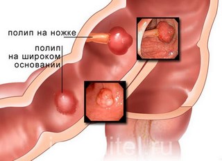 Образование полипов в желудке