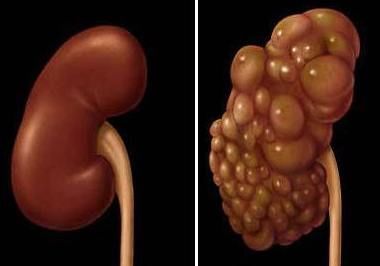 Лечение поликистоза почек народными средствами