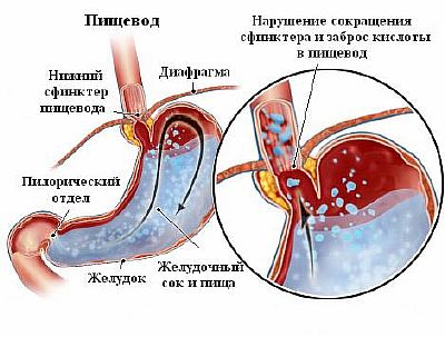 Недостаточность привратника желудка