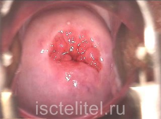 Можно ли вылечить эрозию шейки матки