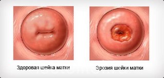 Причины заболевания эрозии шейки матки
