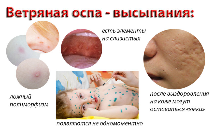 Болезнь ветрянка