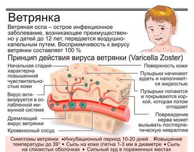 Болезнь ветрянка