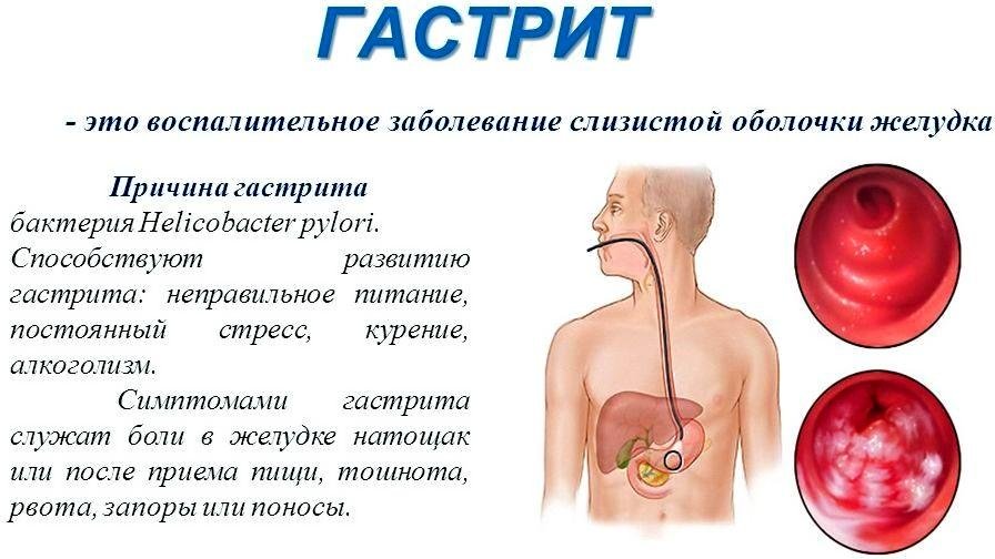Лечение гастрита