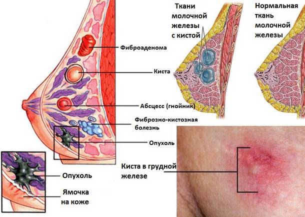 Лечение кисты