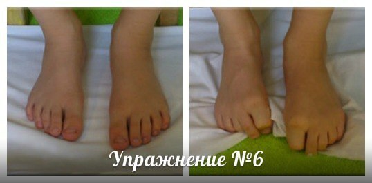 Упражнения при плоскостопии